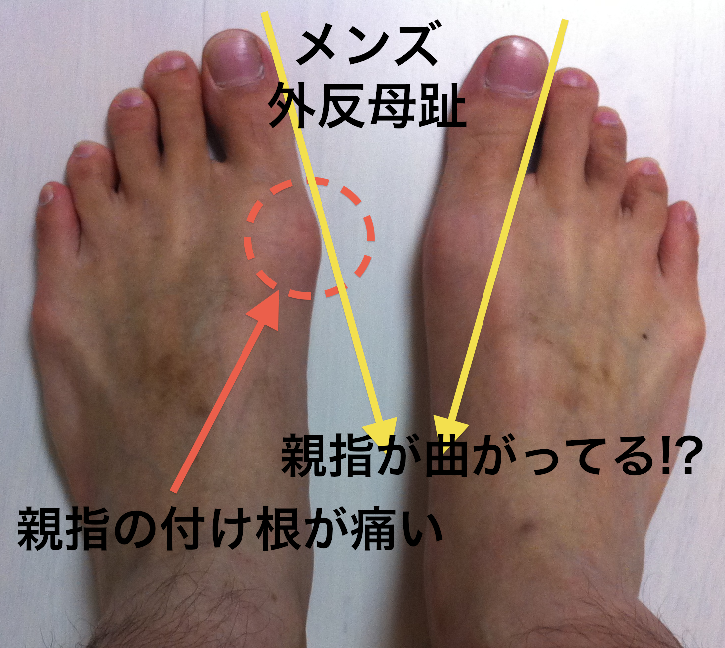 外反母趾でランニングすると危険 男性の外反母趾対策 ソルボ外反母趾サポーター を試してみた